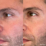 AERIFY COMPLEXION REVIVAL PEELING KIT Before and After Photo by Dr. Emer and Dr. Sanan in West Hollywood California