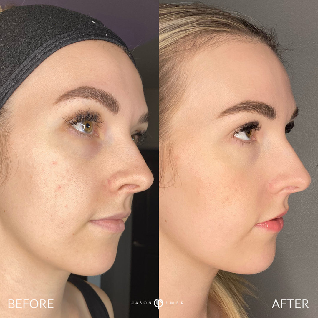 AERIFY COMPLEXION REVIVAL PEELING KIT Before and After Photo by Dr. Emer and Dr. Sanan in West Hollywood California