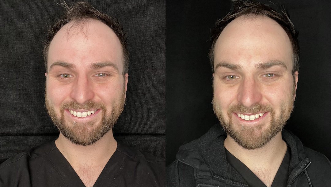 Botox Before and After Photo by Dr. Emer and Dr. Sanan in West Hollywood California