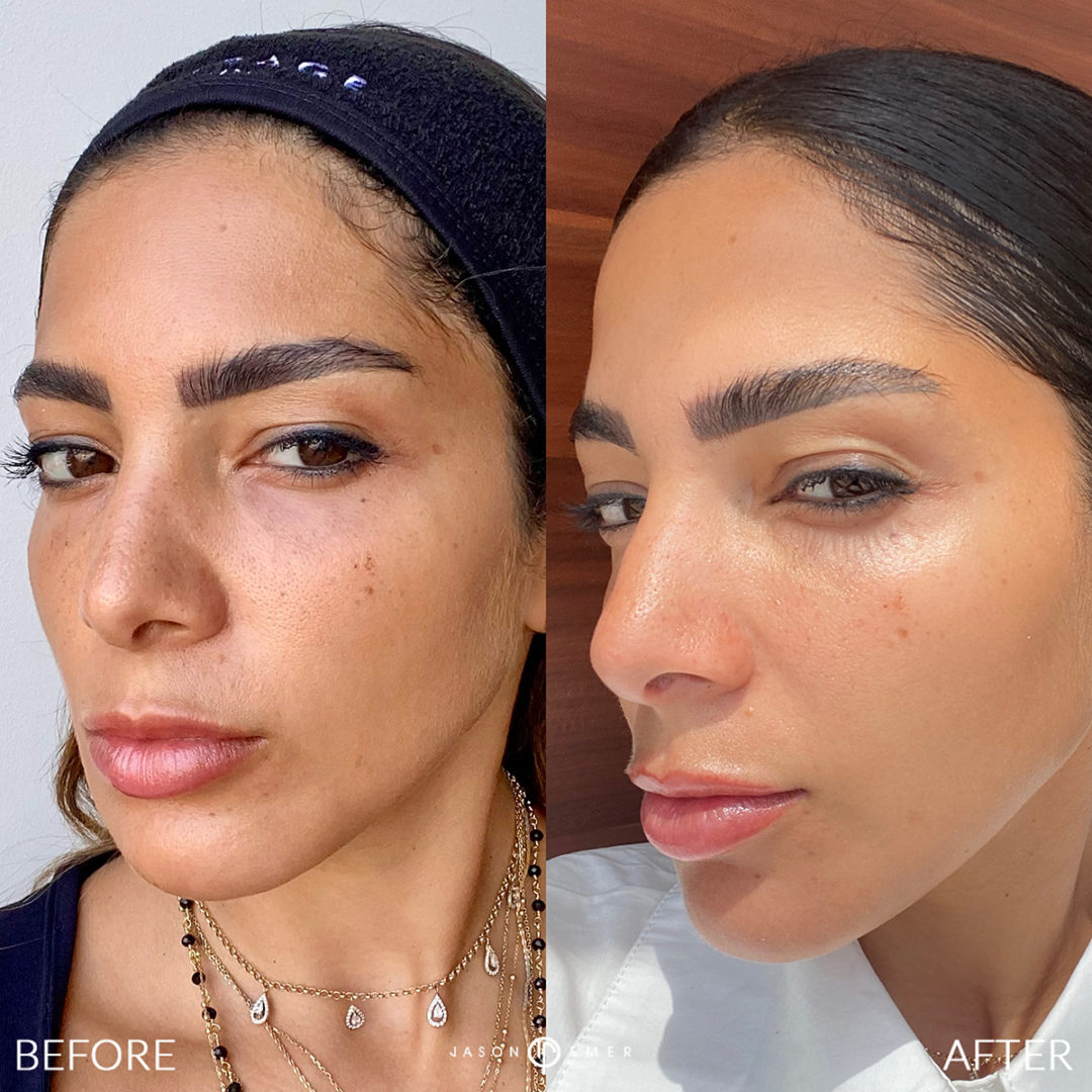 COMPLEXION REVIVAL PEELING KIT Before and After Photo by Dr. Emer and Dr. Sanan in West Hollywood California