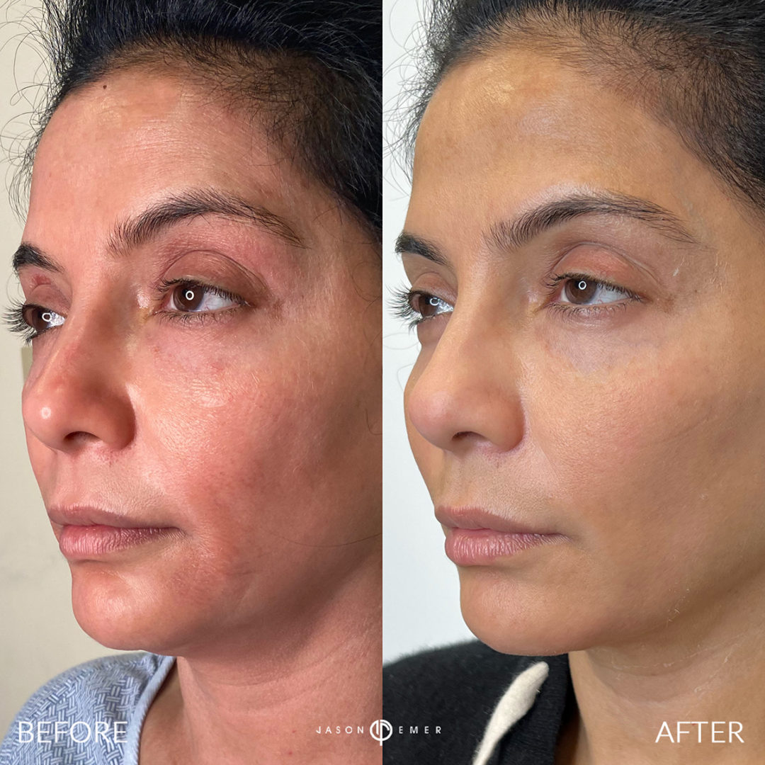 FACIAL REJUVENATION Before and After Photo by Dr. Emer and Dr. Sanan in West Hollywood California