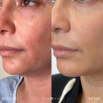 FACIAL REJUVENATION Before and After Photo by Dr. Emer and Dr. Sanan in West Hollywood California