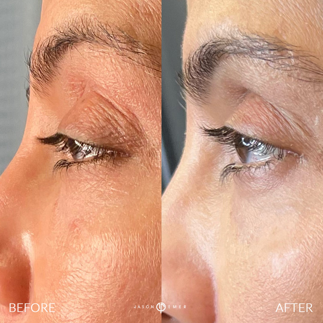 FACIAL REJUVENATION Before and After Photo by Dr. Emer and Dr. Sanan in West Hollywood California