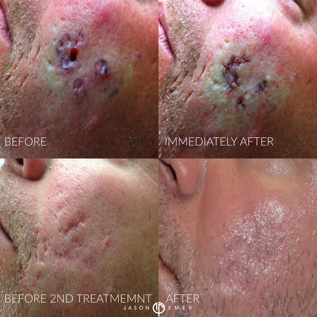 Laser Resurfacing Before and After Photo by Dr. Emer and Dr. Sanan in West Hollywood California