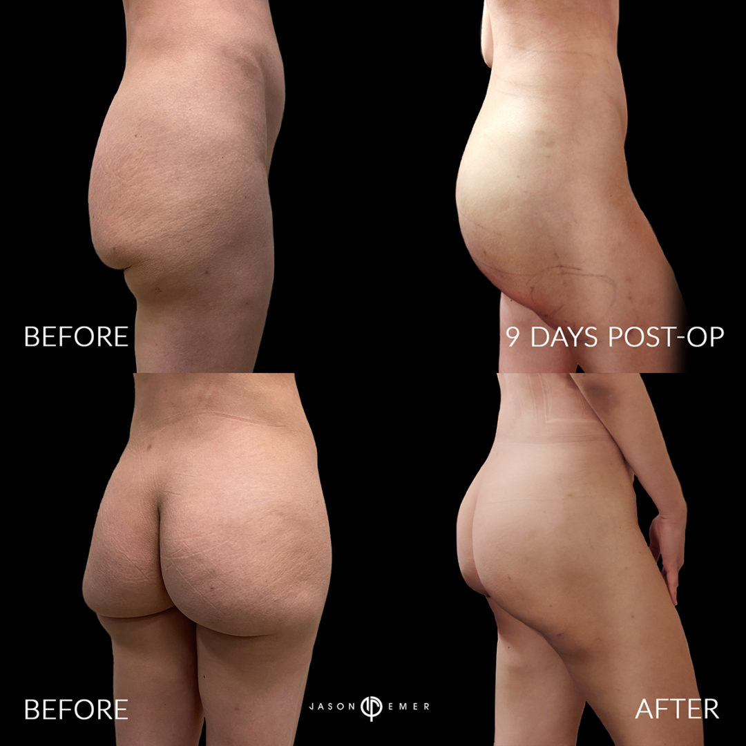 FEMALE SUPERMODEL LIPOSUCTION Before and After Photo by Dr. Emer and Dr. Sanan in West Hollywood California