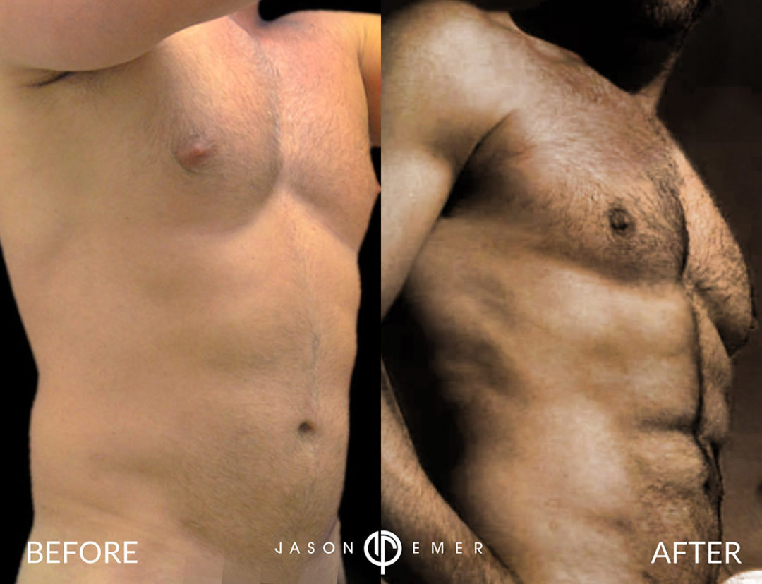 FULL BODY MALE GLADIATOR TRANSFORMATION Before and After Photo by Dr. Emer and Dr. Sanan in West Hollywood California