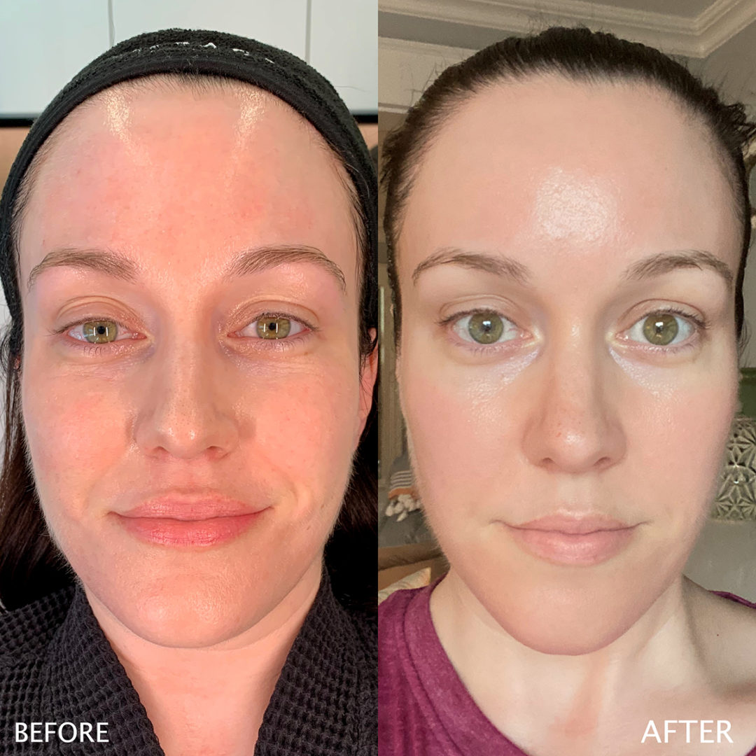 LASER + MICRONEEDLING RF Before and After Photo by Dr. Emer and Dr. Sanan in West Hollywood California