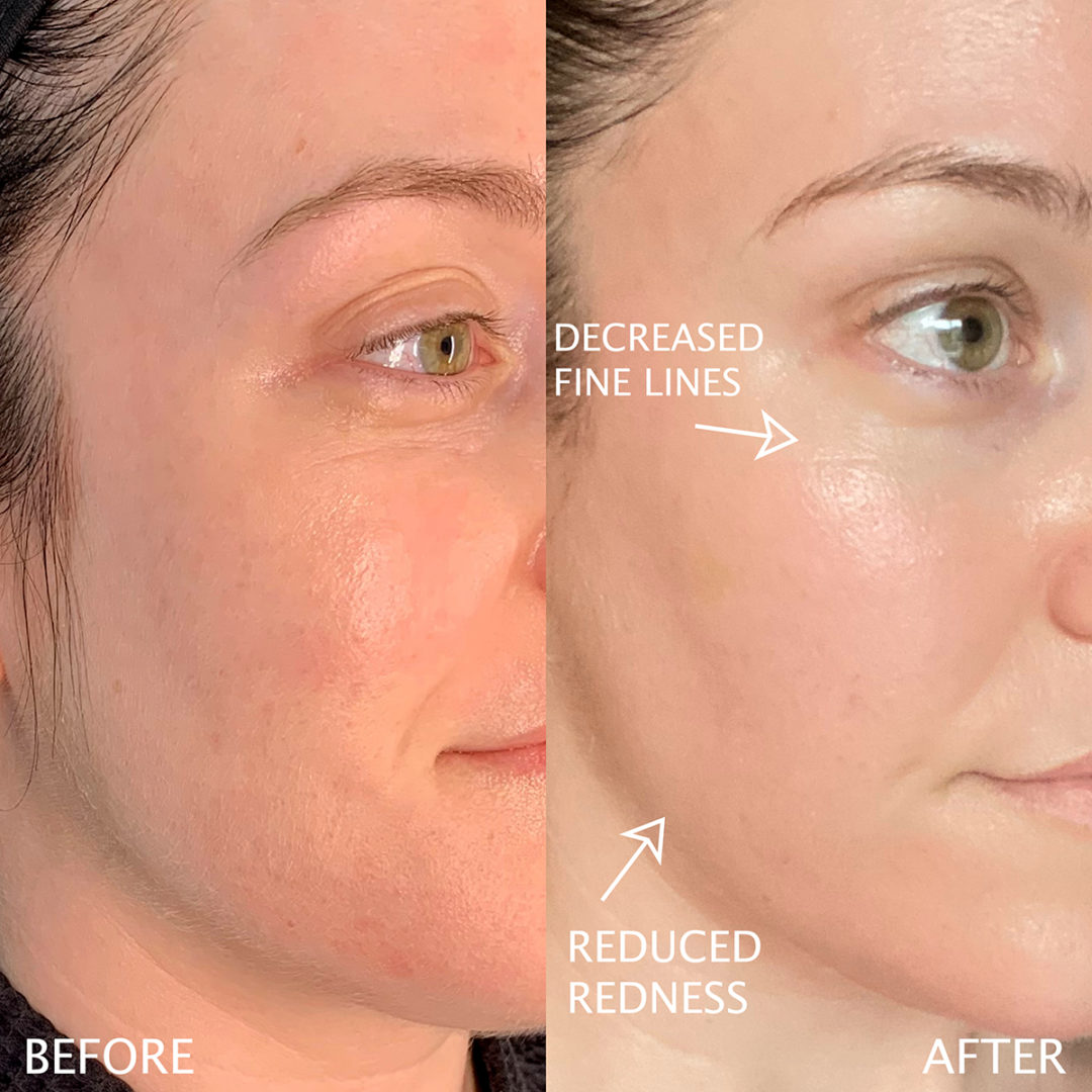 LASER + MICRONEEDLING RF Before and After Photo by Dr. Emer and Dr. Sanan in West Hollywood California