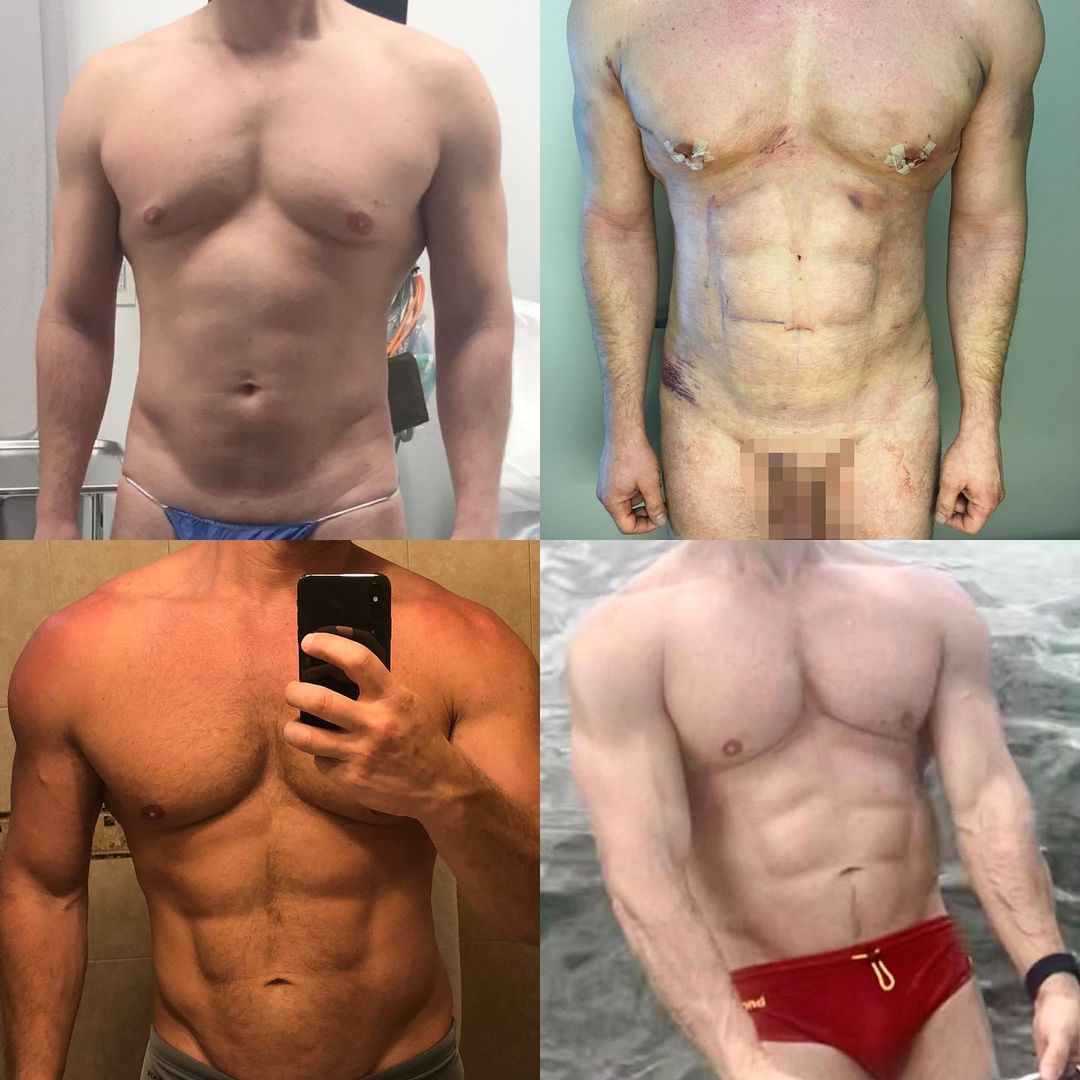 MALE BODY SCULPTING 360 HD-LIPO Before and After Photo by Dr. Emer and Dr. Sanan in West Hollywood California