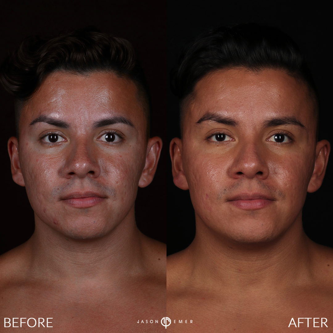 MICRONEEDLING Before and After Photo by Dr. Emer and Dr. Sanan in West Hollywood California