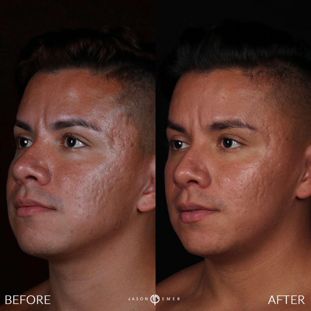 MICRONEEDLING Before and After Photo by Dr. Emer and Dr. Sanan in West Hollywood California