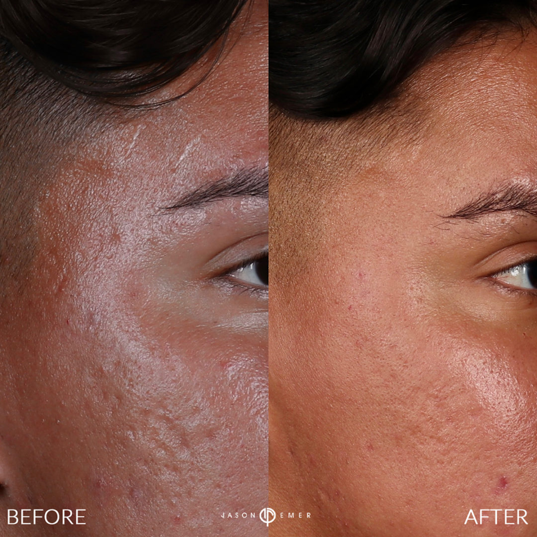 MICRONEEDLING Before and After Photo by Dr. Emer and Dr. Sanan in West Hollywood California