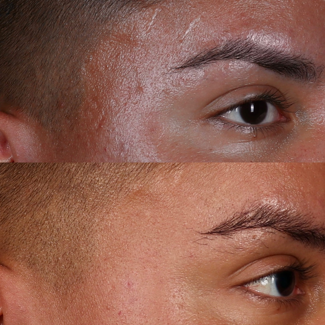 MICRONEEDLING Before and After Photo by Dr. Emer and Dr. Sanan in West Hollywood California