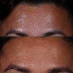 MICRONEEDLING Before and After Photo by Dr. Emer and Dr. Sanan in West Hollywood California