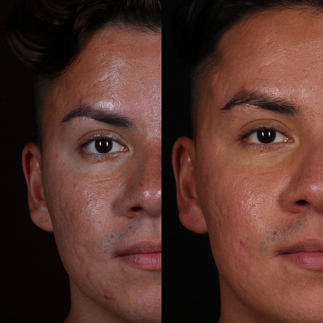 MICRONEEDLING Before and After Photo by Dr. Emer and Dr. Sanan in West Hollywood California