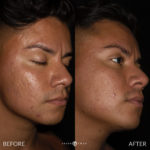 MICRONEEDLING Before and After Photo by Dr. Emer and Dr. Sanan in West Hollywood California