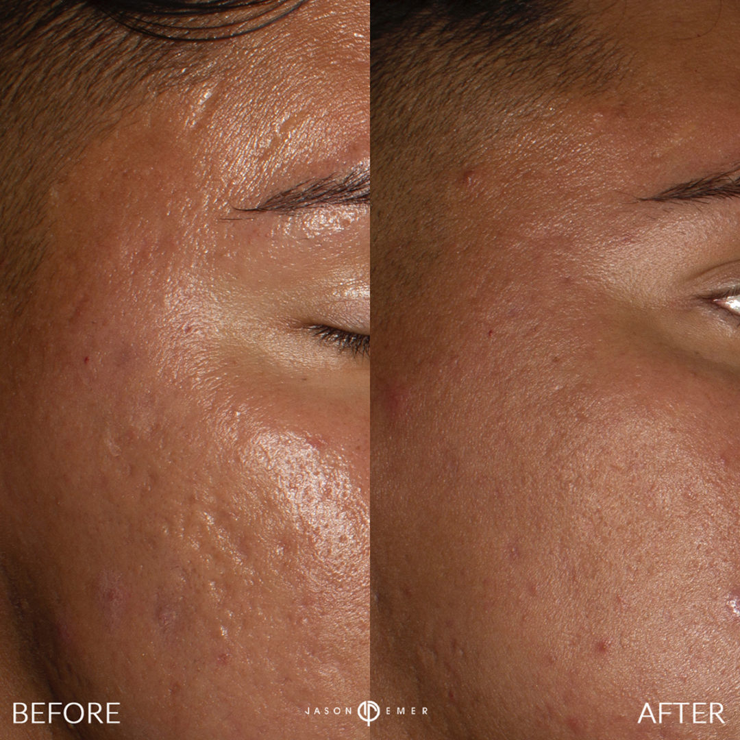 MICRONEEDLING Before and After Photo by Dr. Emer and Dr. Sanan in West Hollywood California