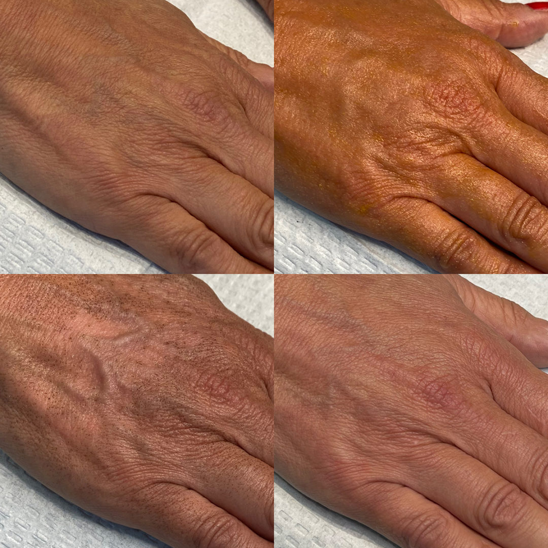 MOXIFY HAND REJUVINATION Before and After Photo by Dr. Emer and Dr. Sanan in West Hollywood California