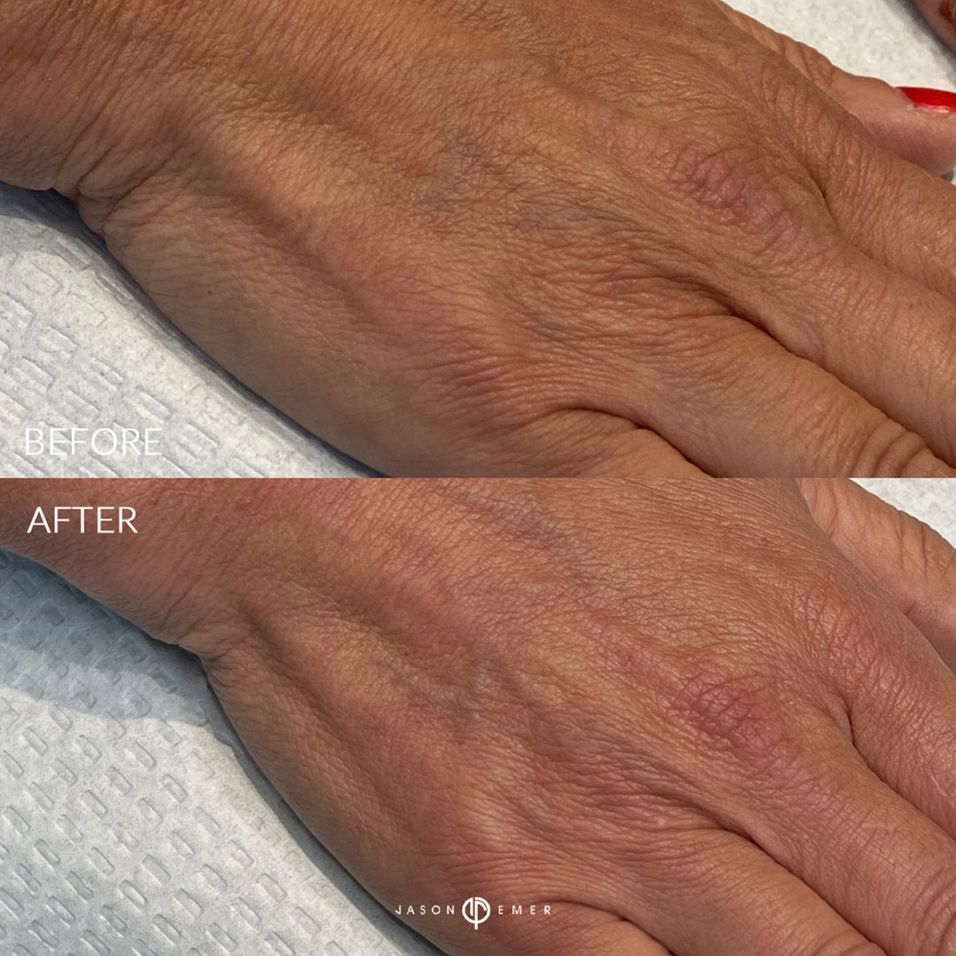 MOXIFY HAND REJUVINATION Before and After Photo by Dr. Emer and Dr. Sanan in West Hollywood California