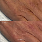 MOXIFY HAND REJUVINATION Before and After Photo by Dr. Emer and Dr. Sanan in West Hollywood California