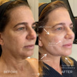 PDO THREAD LIFTING Before and After Photo by Dr. Emer and Dr. Sanan in West Hollywood California