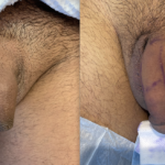 Penile Filler Before and After Photo by Dr. Emer and Dr. Sanan in West Hollywood California