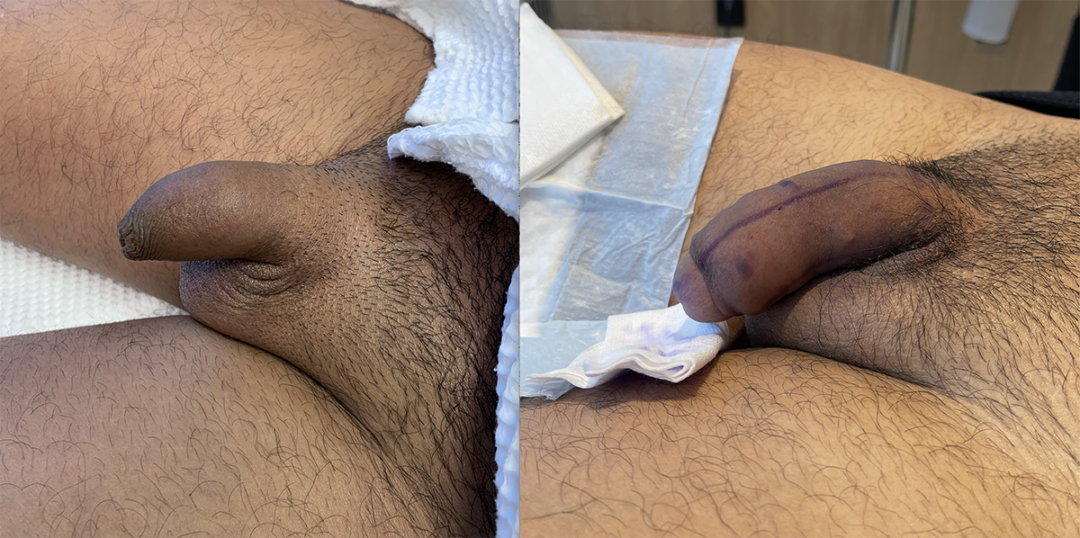 Penile Filler Before and After Photo by Dr. Emer and Dr. Sanan in West Hollywood California