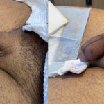 Penile Filler Before and After Photo by Dr. Emer and Dr. Sanan in West Hollywood California