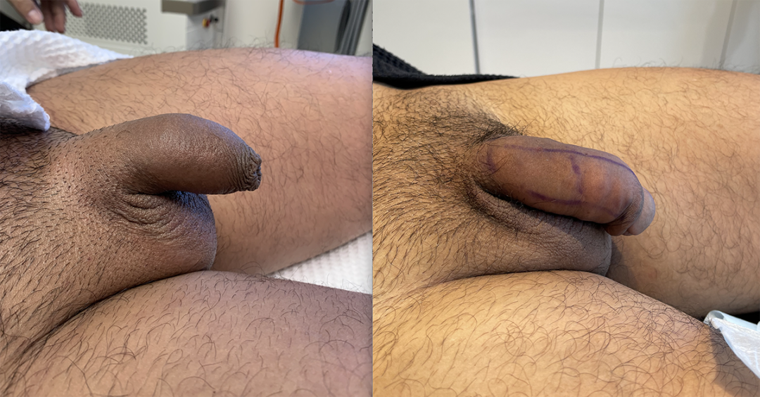 Penile Filler Before and After Photo by Dr. Emer and Dr. Sanan in West Hollywood California