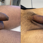 Penile Filler Before and After Photo by Dr. Emer and Dr. Sanan in West Hollywood California