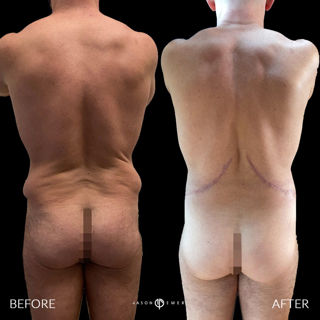 SNATCH YOUR BACK | BODY LIFT + REVISION LIPOSUCTION Before and After Photo by Dr. Emer and Dr. Sanan in West Hollywood California