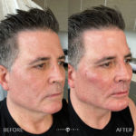 SUPERHERO FACIAL MASCULINIZATION Before and After Photo by Dr. Emer and Dr. Sanan in West Hollywood California