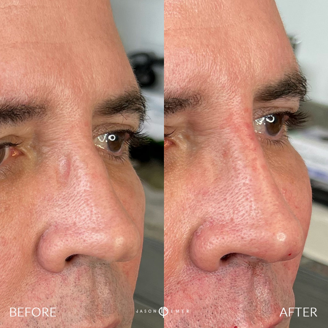 SUPERHERO FACIAL MASCULINIZATION Before and After Photo by Dr. Emer and Dr. Sanan in West Hollywood California