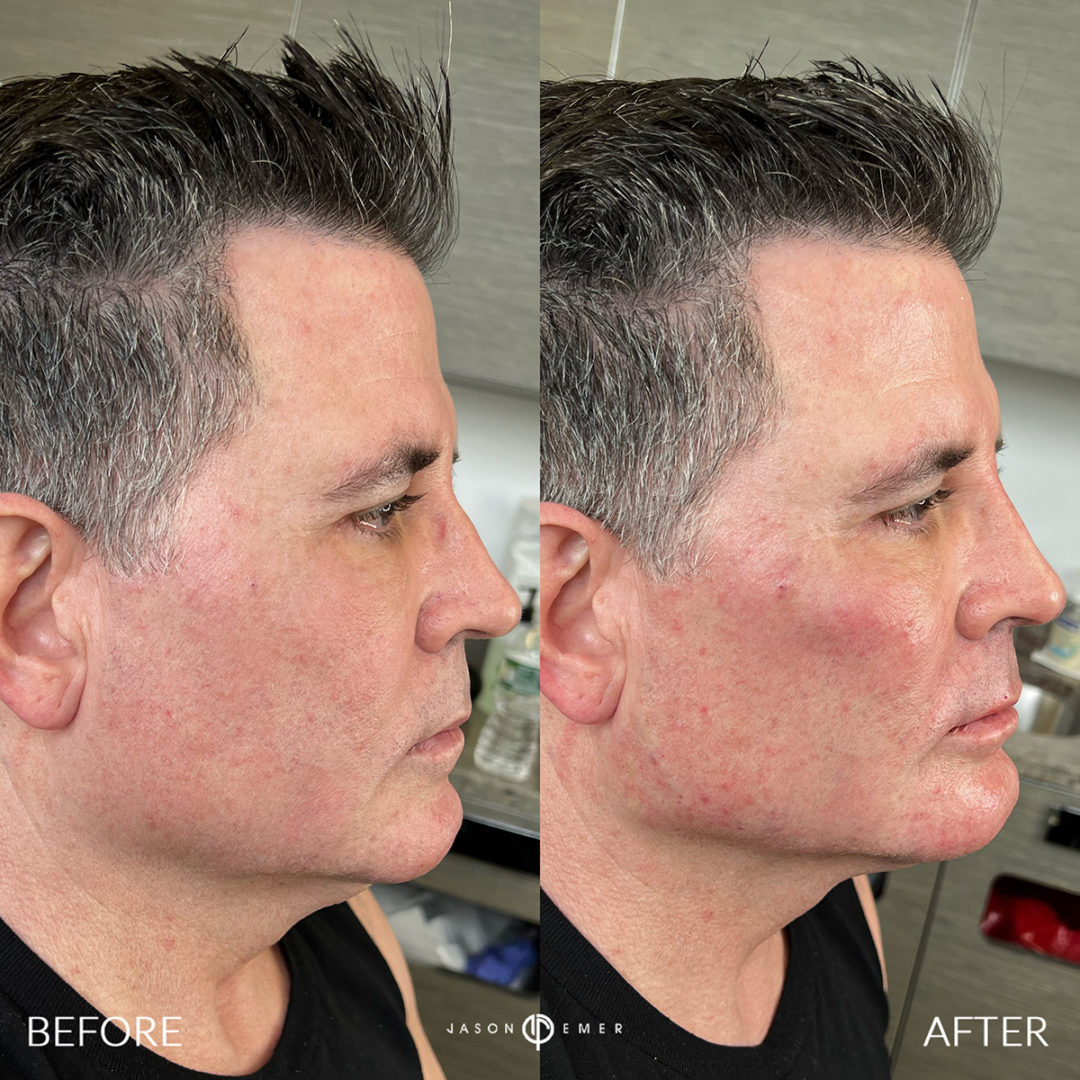 SUPERHERO FACIAL MASCULINIZATION Before and After Photo by Dr. Emer and Dr. Sanan in West Hollywood California