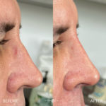 SUPERHERO FACIAL MASCULINIZATION Before and After Photo by Dr. Emer and Dr. Sanan in West Hollywood California