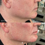 SUPERHERO FACIAL MASCULINIZATION Before and After Photo by Dr. Emer and Dr. Sanan in West Hollywood California