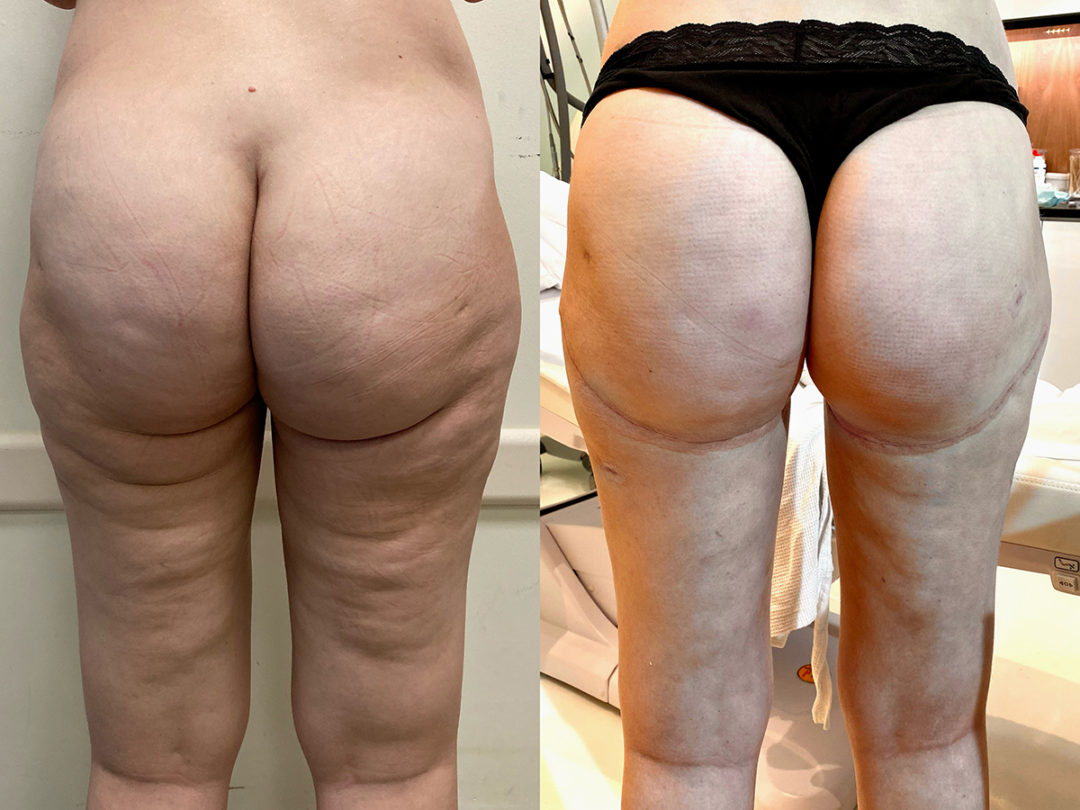 Spiral Thigh Lift Before and After Photo by Dr. Emer and Dr. Sanan in West Hollywood California