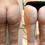 Spiral Thigh Lift Before and After Photo by Dr. Emer and Dr. Sanan in West Hollywood California