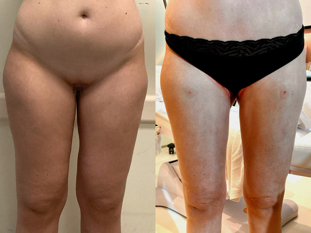 Spiral Thigh Lift Before and After Photo by Dr. Emer and Dr. Sanan in West Hollywood California