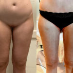 Spiral Thigh Lift Before and After Photo by Dr. Emer and Dr. Sanan in West Hollywood California