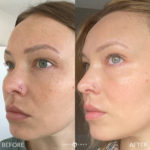 MICRONEEDLING Before and After Photo by Dr. Emer and Dr. Sanan in West Hollywood California