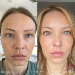 MICRONEEDLING Before and After Photo by Dr. Emer and Dr. Sanan in West Hollywood California