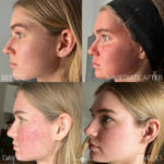 Bellafill Before and After Photo by Dr. Emer and Dr. Sanan in West Hollywood California