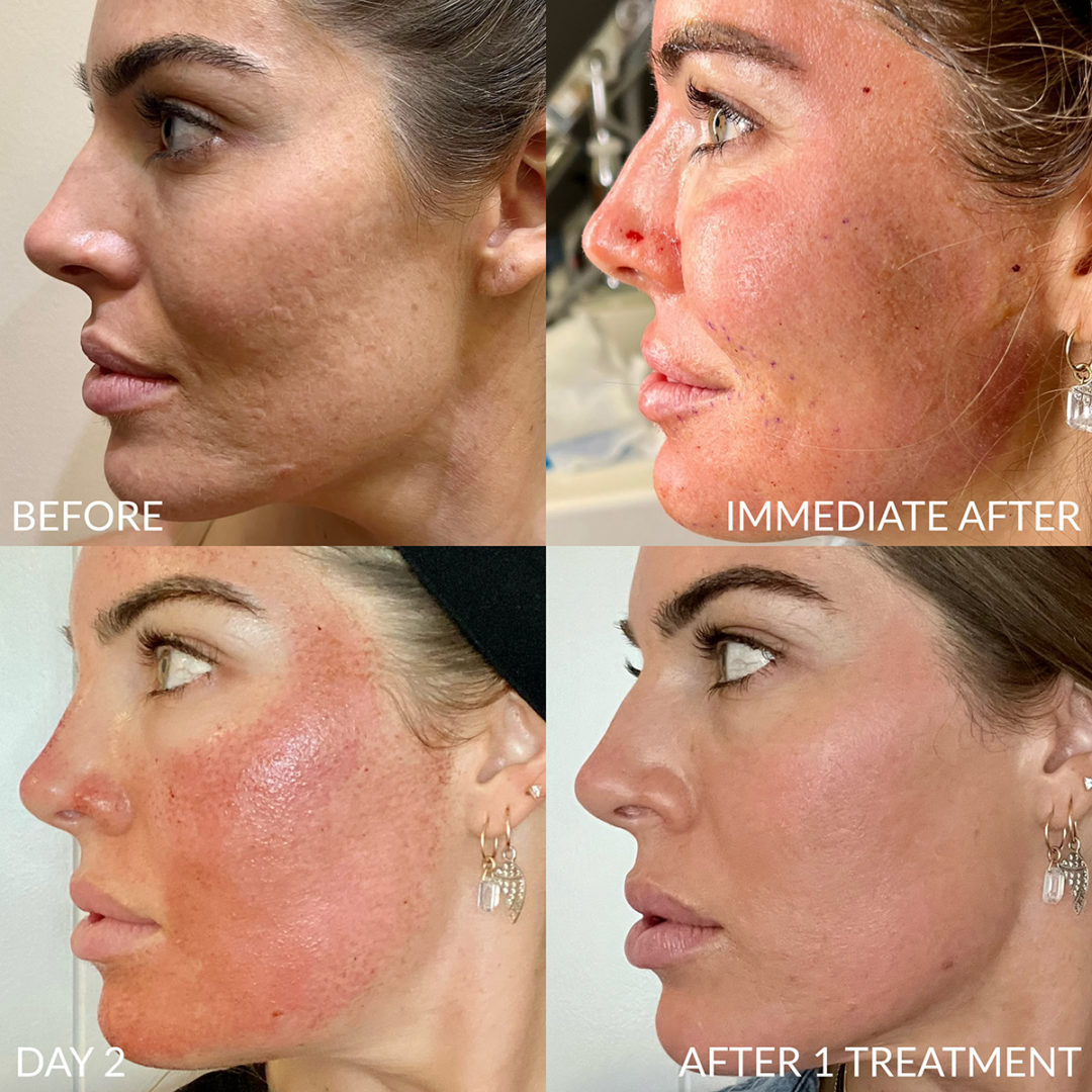 Bellafill Before and After Photo by Dr. Emer and Dr. Sanan in West Hollywood California