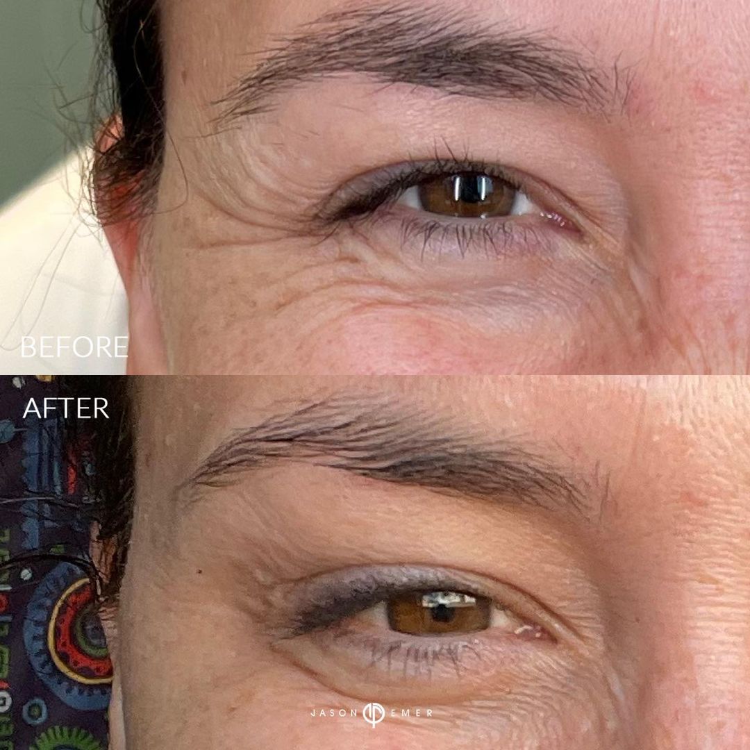 Botox Before and After Photo by Dr. Emer and Dr. Sanan in West Hollywood California