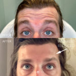 Botox Before and After Photo by Dr. Emer and Dr. Sanan in West Hollywood California