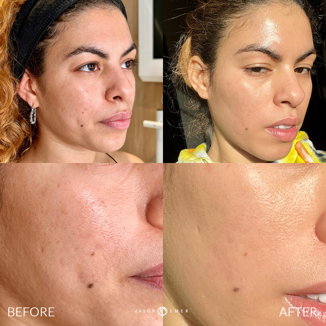 Chemical Peels Before and After Photo by Dr. Emer and Dr. Sanan in West Hollywood California