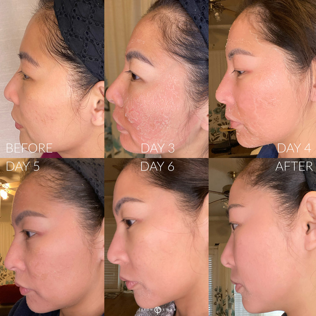 Chemical Peels Before and After Photo by Dr. Emer and Dr. Sanan in West Hollywood California