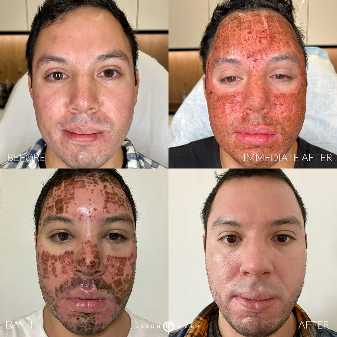 CO2 Laser Resurfacing Before and After Photo by Dr. Emer and Dr. Sanan in West Hollywood California