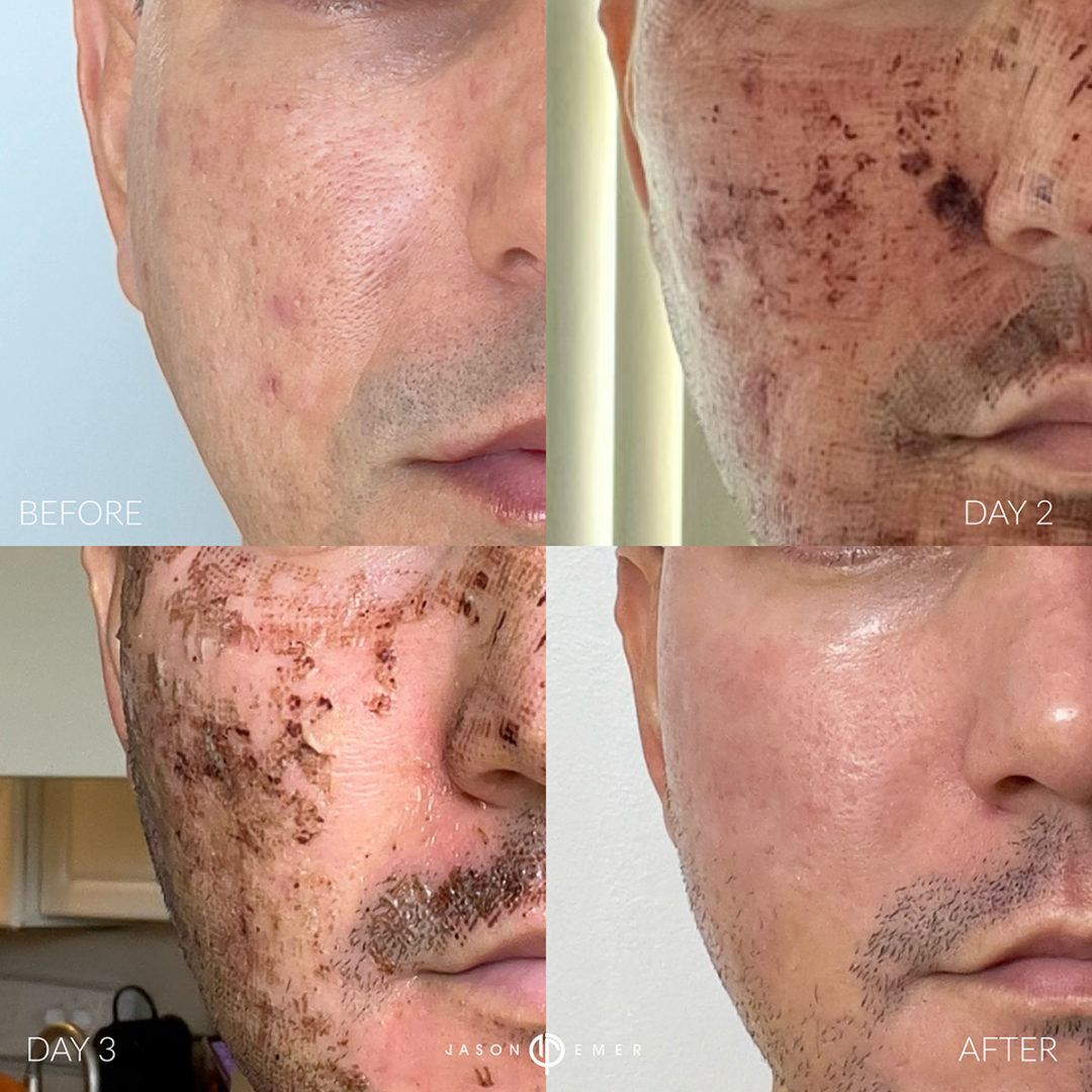 CO2 Laser Resurfacing Before and After Photo by Dr. Emer and Dr. Sanan in West Hollywood California